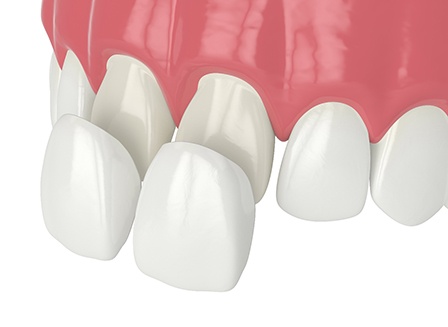 Illustration of veneers being placed on two front teeth