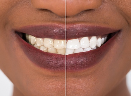 Closeup of patient's smile before and after teeth whitening
